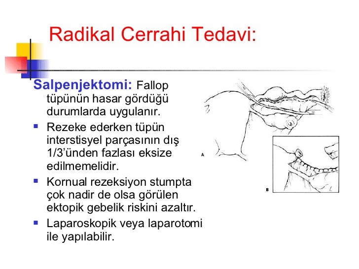Ektopik gebelik: cerrahi ve tedavi Ektopik gebelik: cerrahi ve tedavi
